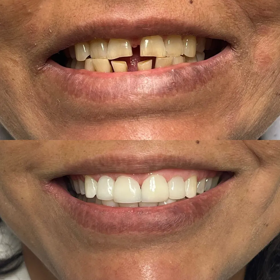 Antes e depois real de um tratamento de facetas da Dra. Priscilla Samberg: dentes desalinhados e amarelados transformados em um sorriso alinhado e branco